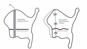 Can You Reverse Voice Deepening?