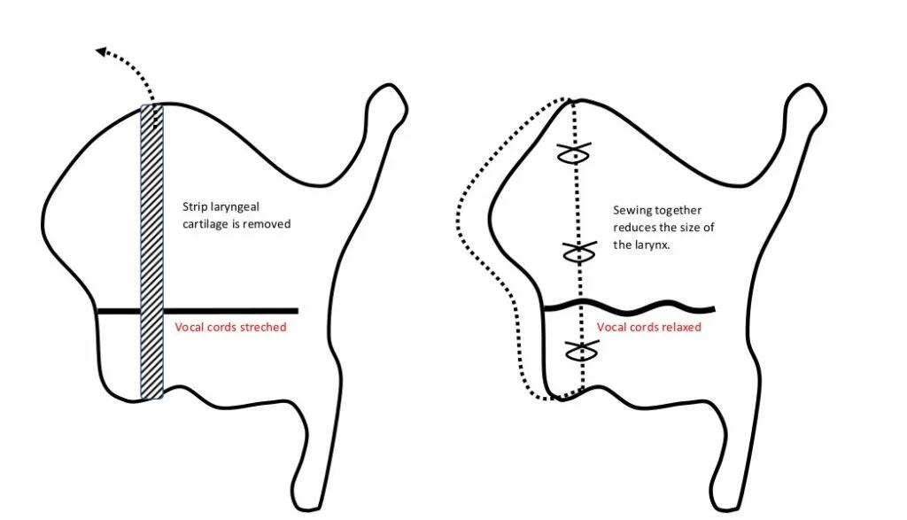Can You Reverse Voice Deepening? Options, Limits And Voice Therapy Support